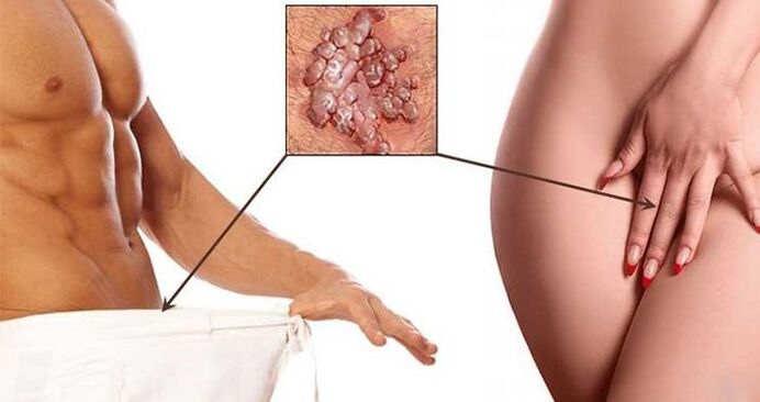 Condilomas na área genital de homens e mulheres