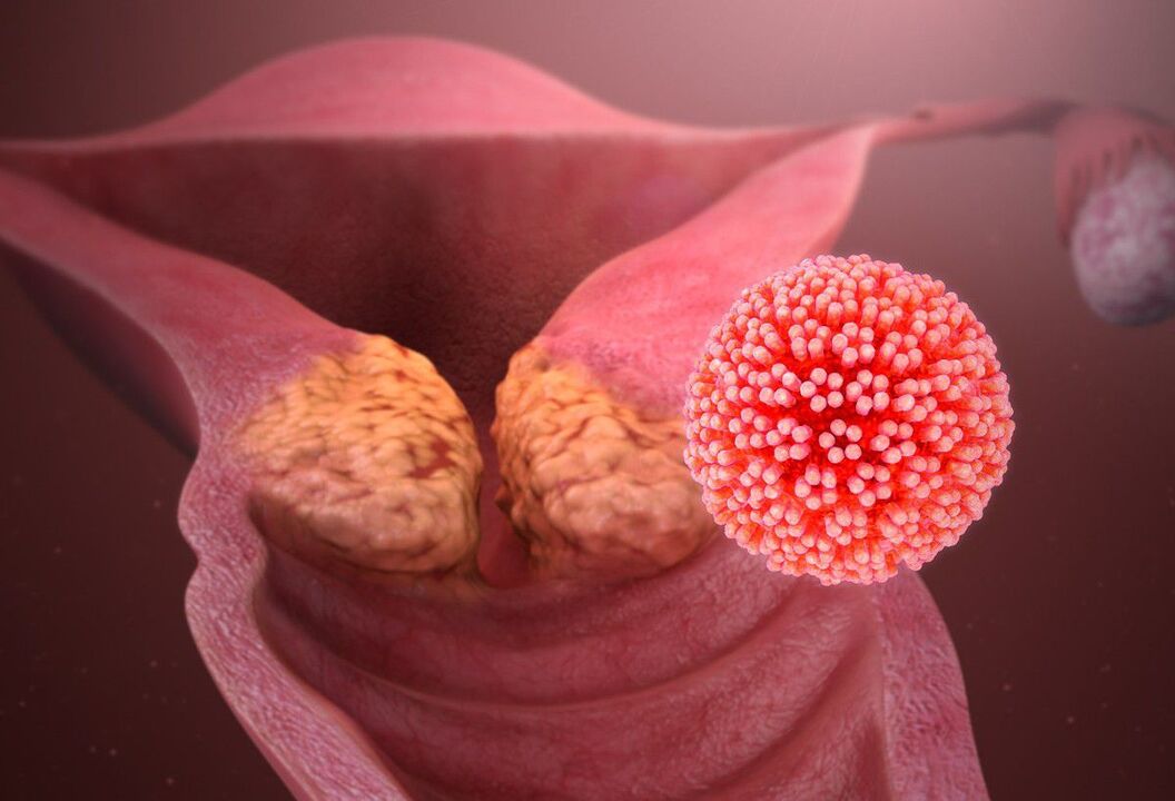 Lesão de HPV do colo do útero