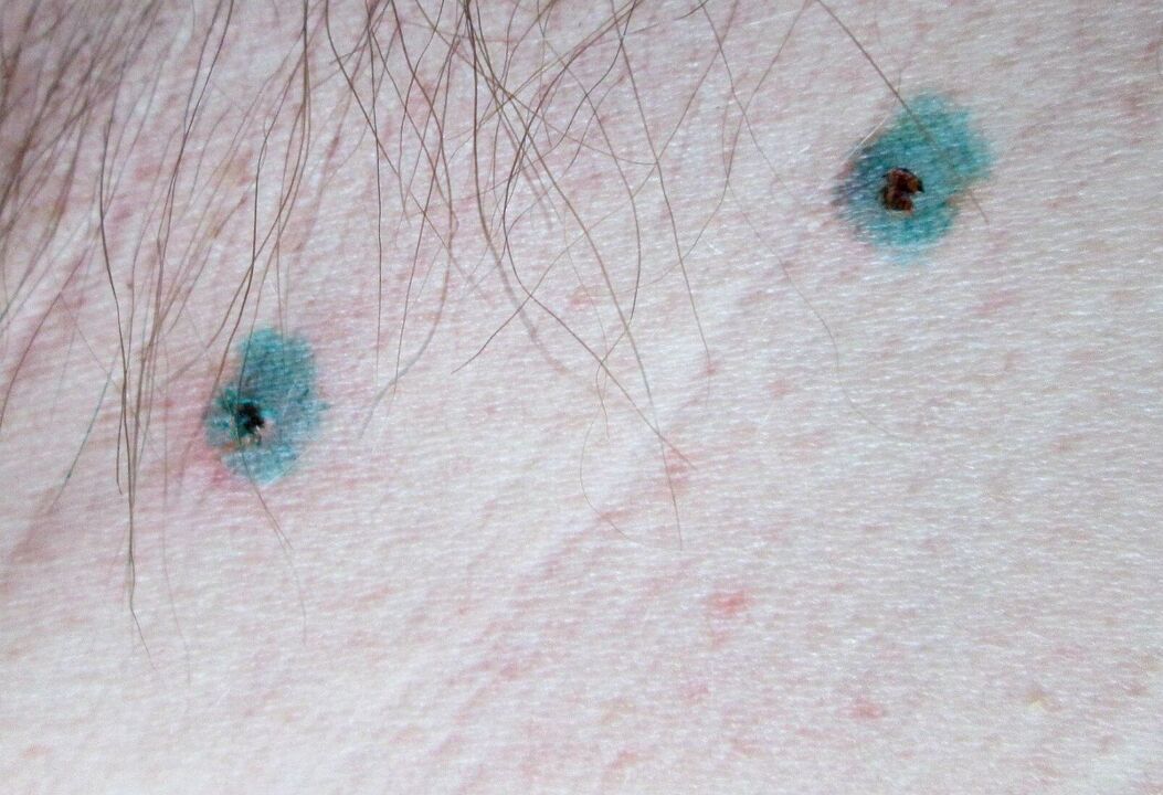 Marcas na pele após remoção de papilomas a laser