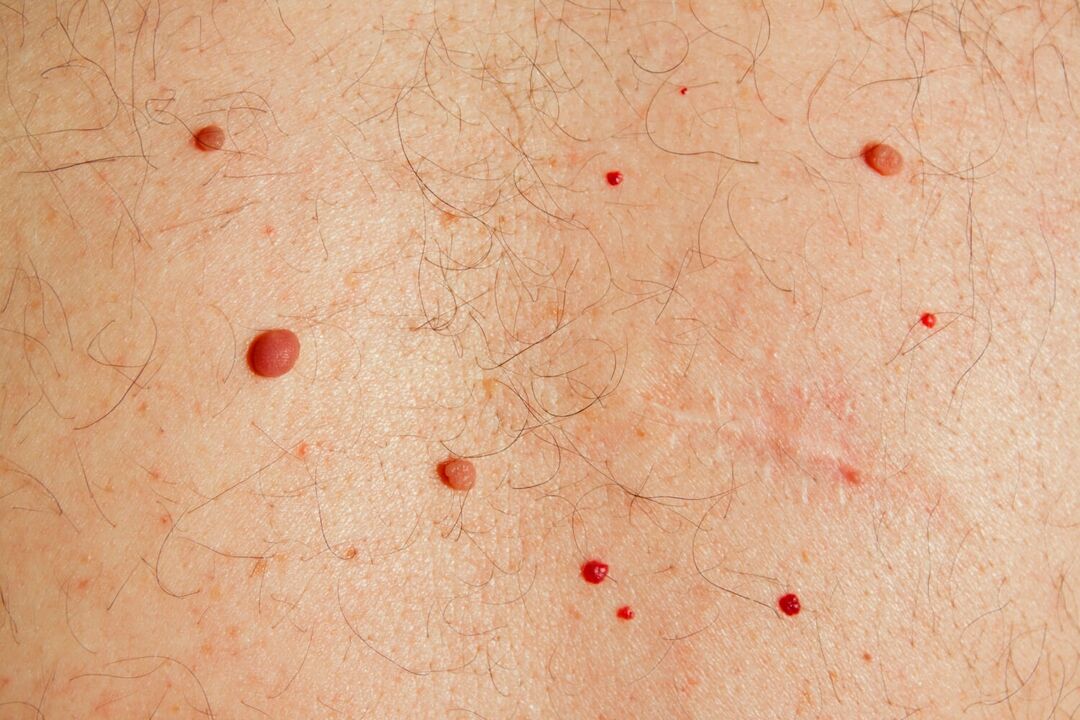 Papilomas no corpo causados ​​​​por HPV